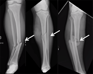 fratura de tibia