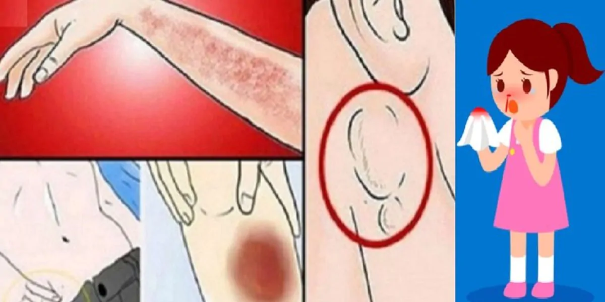 10 Sinais de Leucemia que nunca devem ser ignorados por ninguém