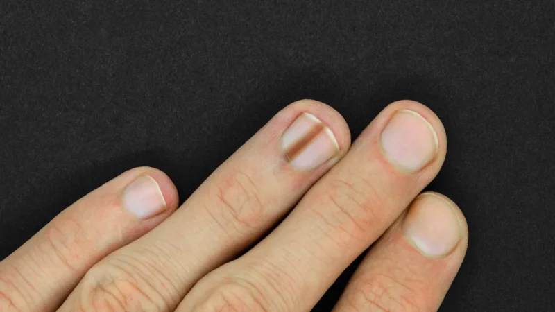 Médico Revela 5 Doenças Graves que Suas Unhas Podem Revelar, e Entre Elas Está o Cânc…Ver mais
