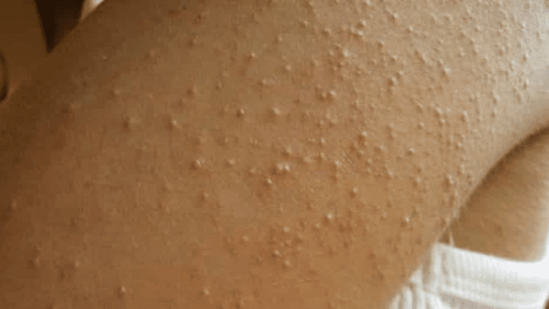 Bolinhas Brancas Em Algumas Partes Do Corpo Pode Se Sinal De Ca… Ver Mais