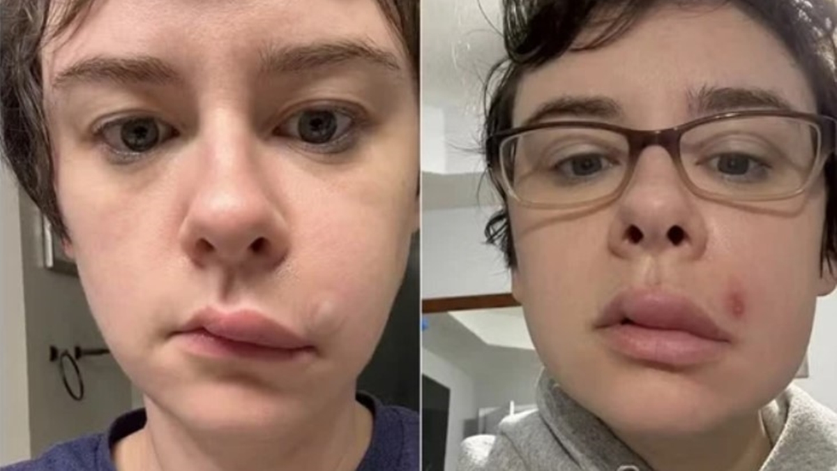 Jovem Vai Às Pressas Ao Hospital Logo Após Espremer Espinha No Rosto, Ela Teve Uma… Ver Mais