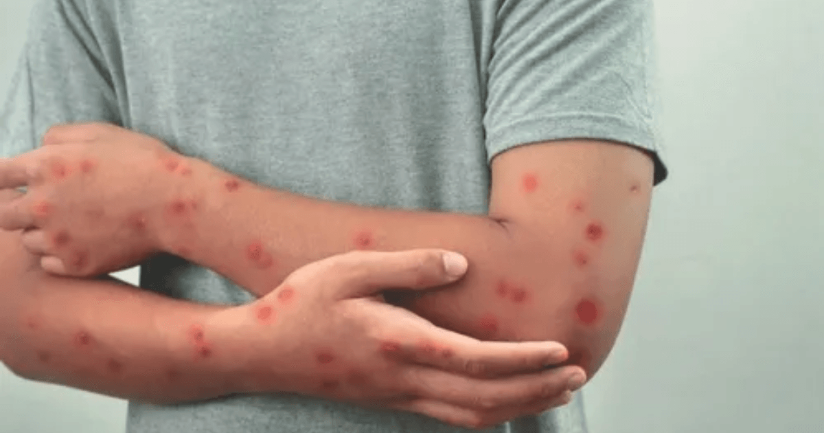 Mpox: nova doença assusta brasileiros com casos crescendo em todo o país