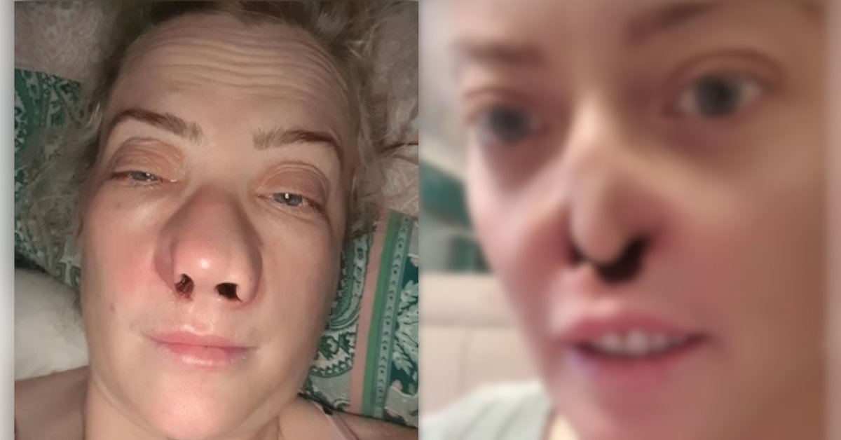 Só Veja se Tiver Estômag0! Imagem do Rosto da Mulher Após Implante é de Arrepi4r, Ficou um Burac… Ver Mais