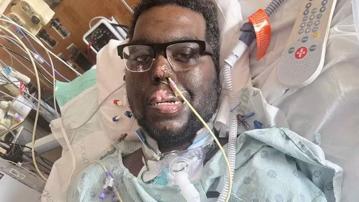 Homem perd3 braços e pernas após ida ao dentista e detalhe nas gengivas assust4 médicos… Ler Mais