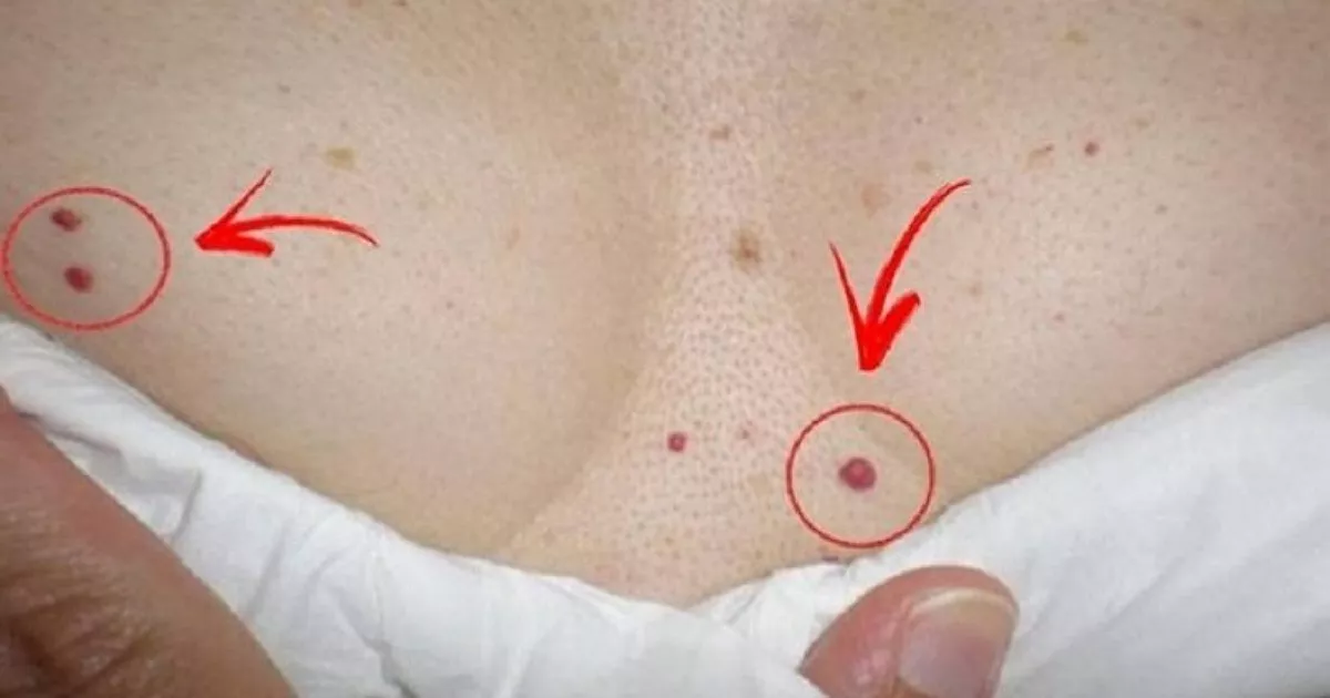 Fique alerta se surgirem bolinhas vermelhas em seu corpo; saiba o porque… Ler Matéria