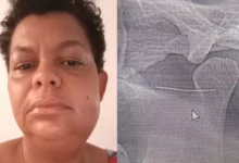 Nilda Lopes enfrenta sequelas e pode precisar de uma sexta cirurgia apos agulha quebrar durante anestesia odontologica