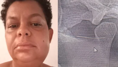 Nilda Lopes enfrenta sequelas e pode precisar de uma sexta cirurgia apos agulha quebrar durante anestesia odontologica