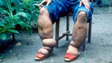 elefantiase filariose linfatica causas tratamento